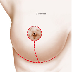 Cicatrice t inverse du sein